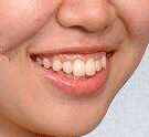 儿童如何预防双颌前突形成的露龈笑